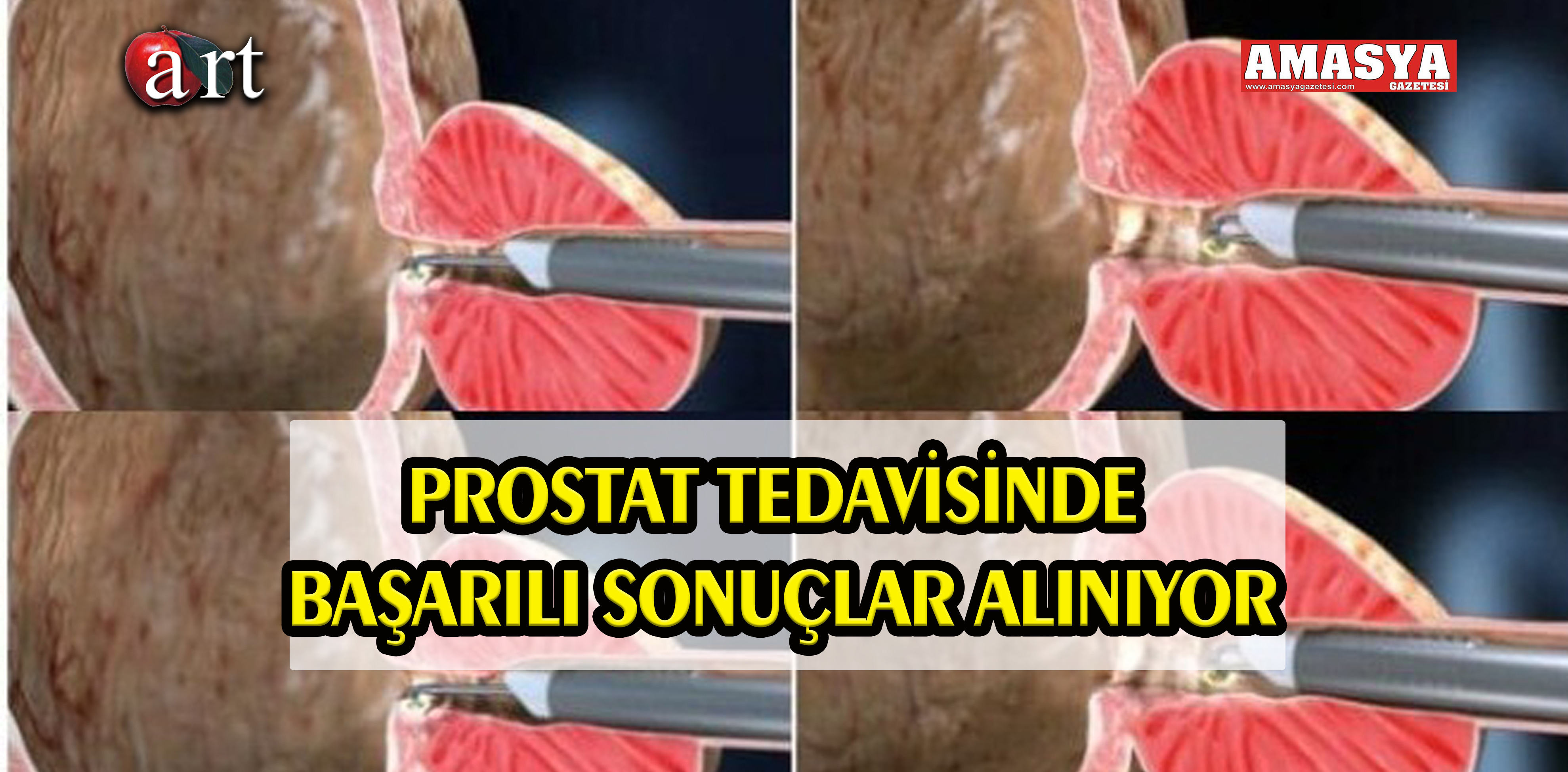 PROSTAT TEDAVİSİNDE BAŞARILI SONUÇLAR ALINIYOR